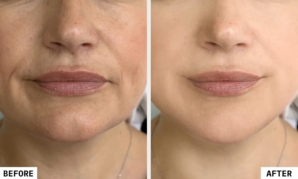 Derma Filler
