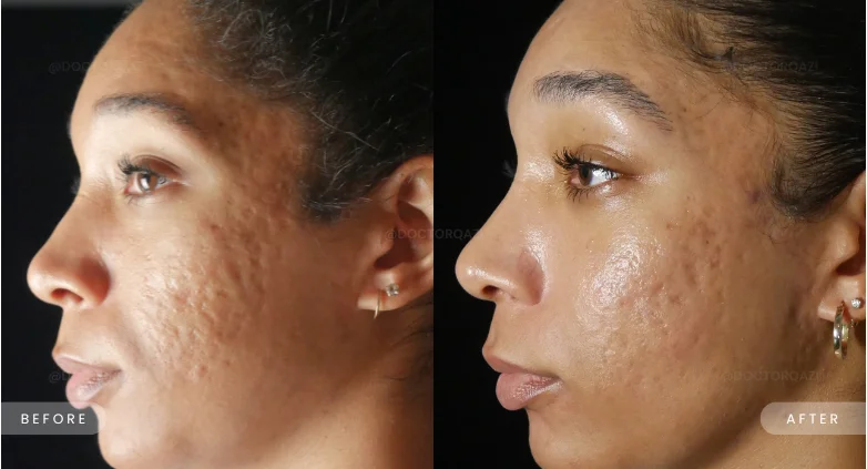 MNRF (Microneedling with RF) at Madika Aesthetics