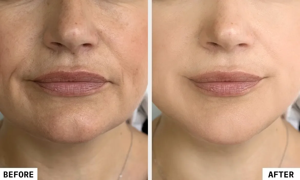 Injectables and fillers