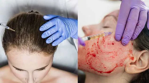 Hair restoration treatment