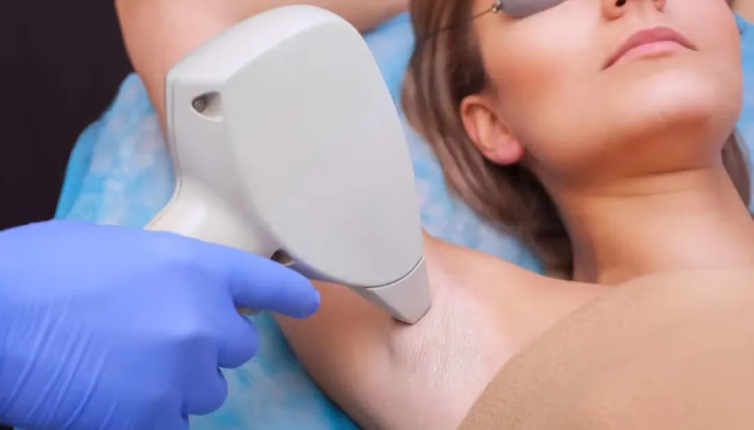 Laser hair removal