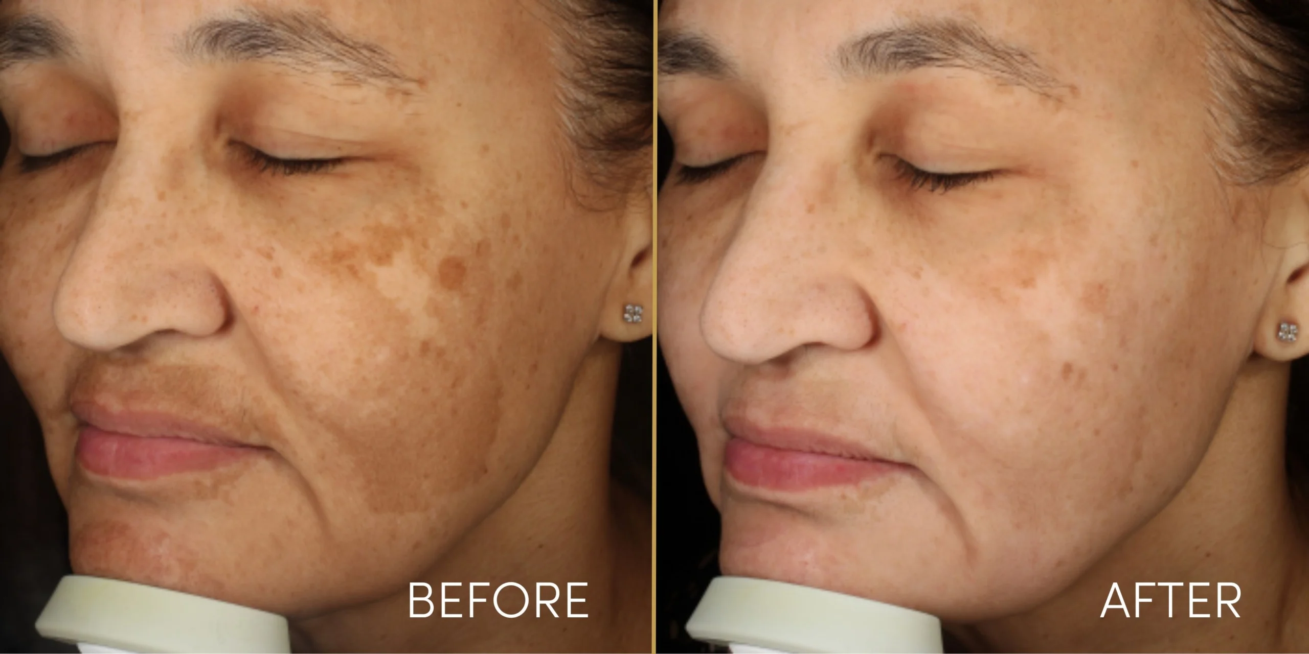 Pigmentation Treatment