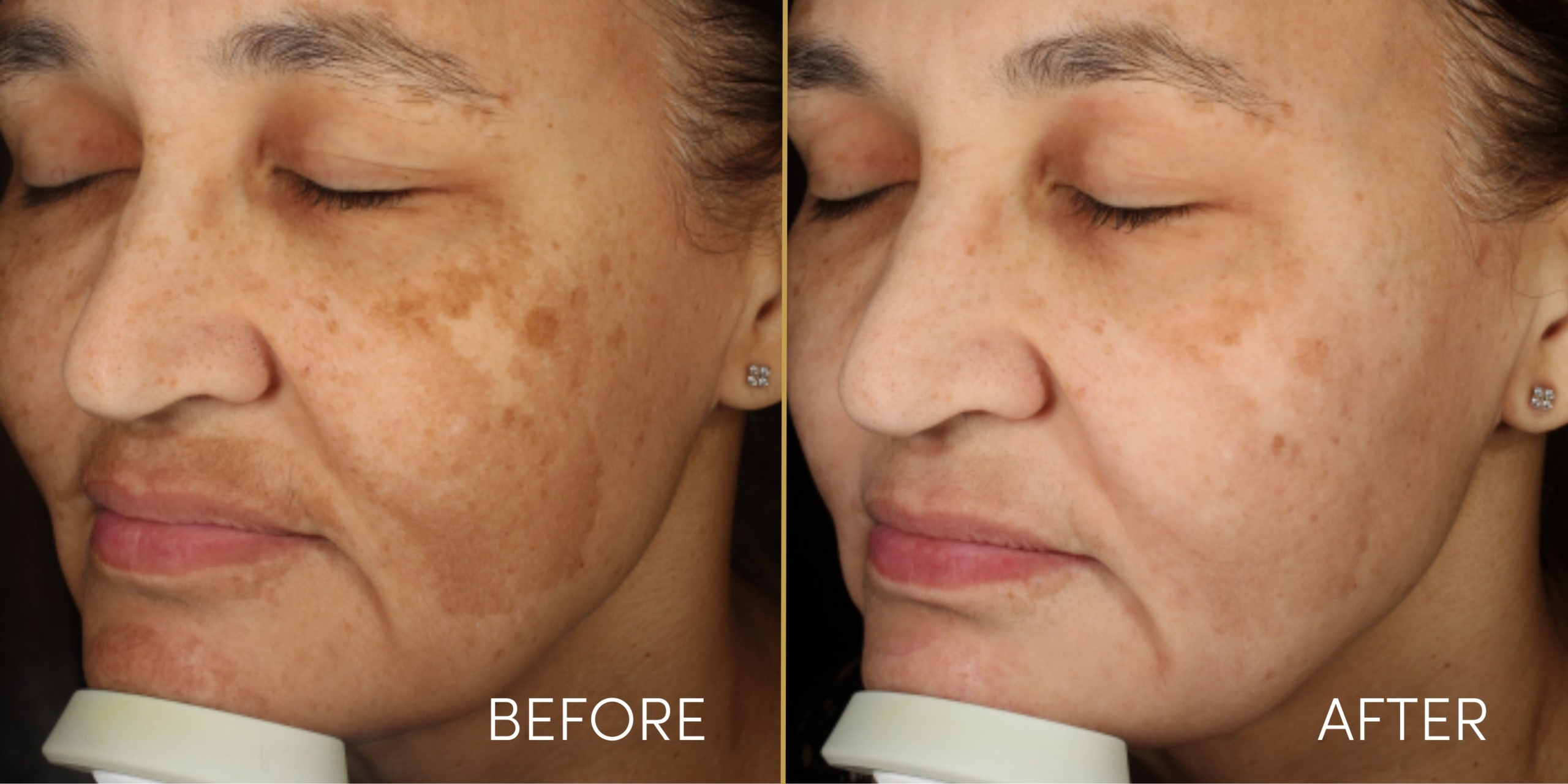 Pigmentation Treatment