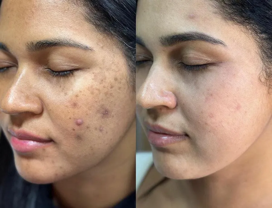 Acne treatment before and after at Madika Aesthetics