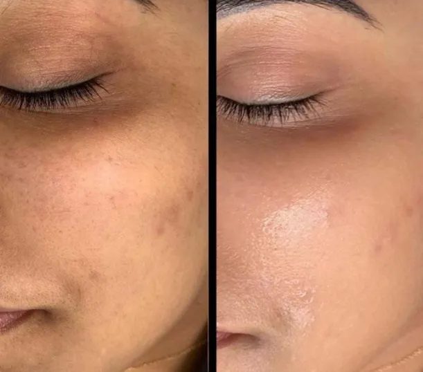 Face PRP before and after at Madika Aesthetics