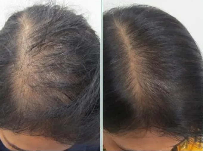 Hair GFC before and after at Madika Aesthetics