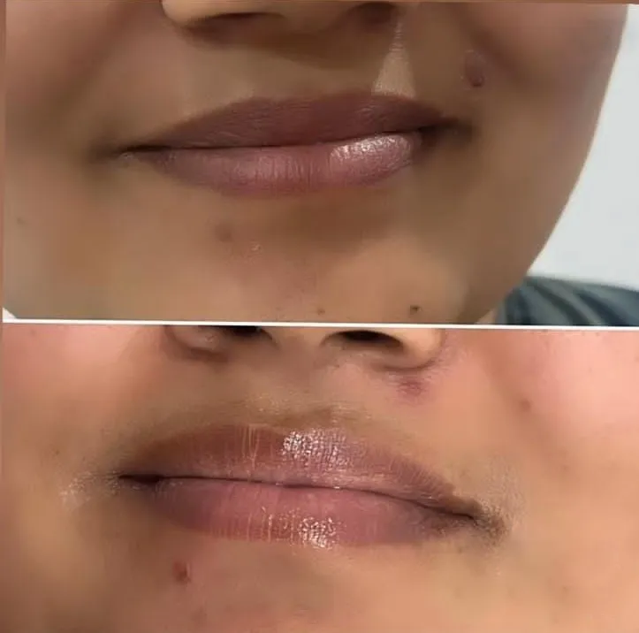 Lip neutralization before and after at Madika Aesthetics