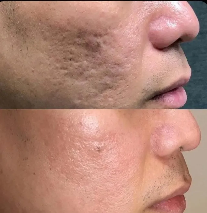 MNRF before and after at Madika Aesthetics