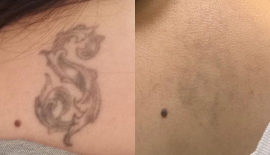 Tattoo Removal